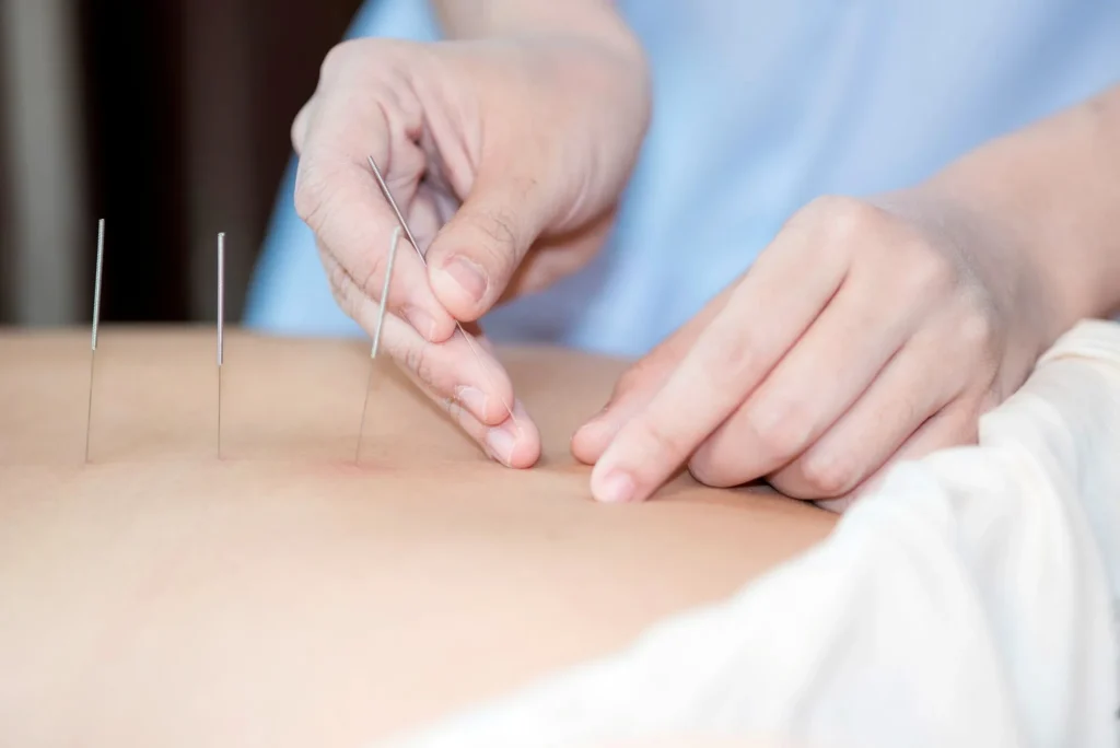 The physiotherapist is doing acupuncture on the back of a female patient - Acupressure