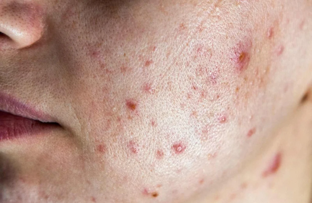 clogged pores and pimples