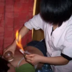 A cupping therapist is using a glass cup for the cupping massage