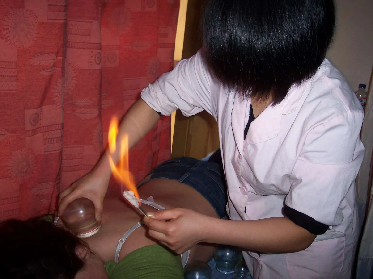 A cupping therapist is using a glass cup for the cupping massage