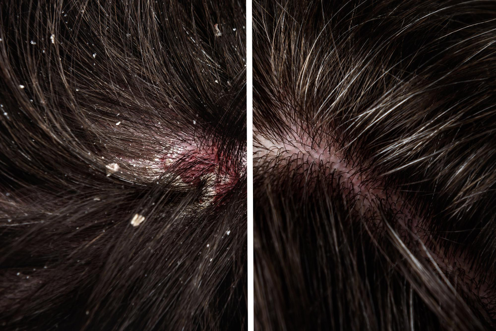 Before and after dandruff treatment - Dandruff in the hair - Benefits of hair spa 